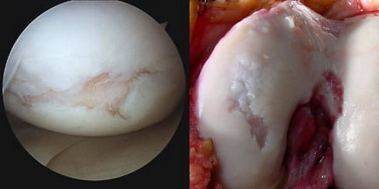 durante l'operazione è visibile un danno all'articolazione del ginocchio