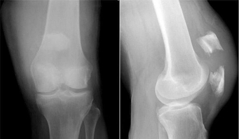 radiografia del ginocchio