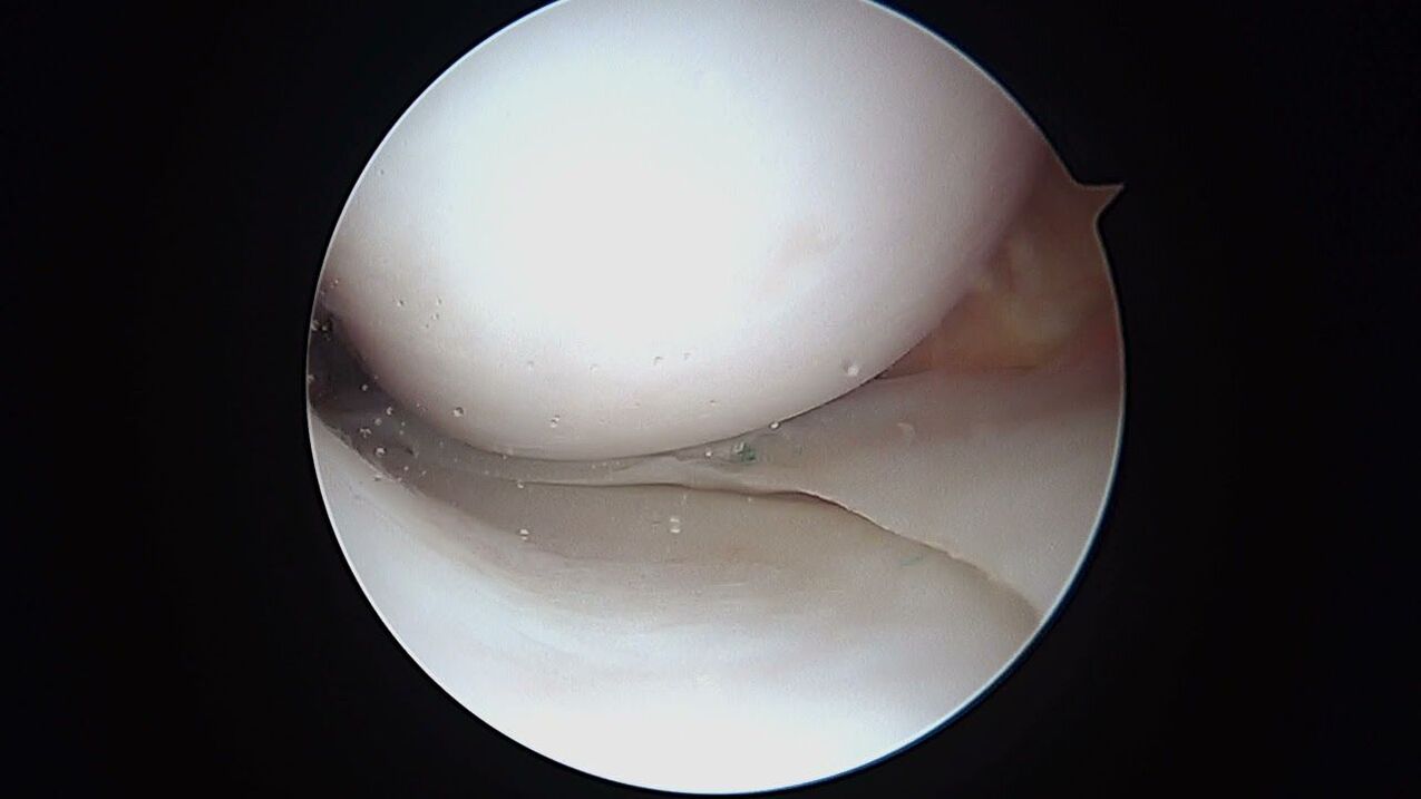 vista dell'articolazione del ginocchio attraverso l'artroscopio
