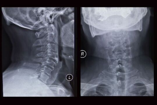 Immagine a raggi X del rachide cervicale (il paziente ha l'osteocondrosi)
