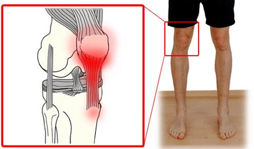 La tendinite è un'infiammazione del tessuto tendineo che provoca dolore all'articolazione del ginocchio. 
