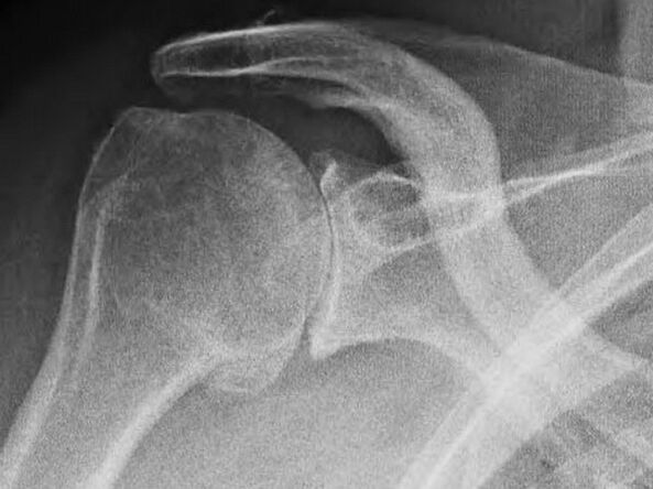 Radiografia di un'articolazione della spalla affetta da artrosi