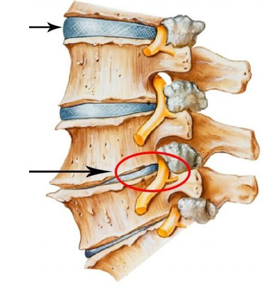 osteocondrosi cervicale