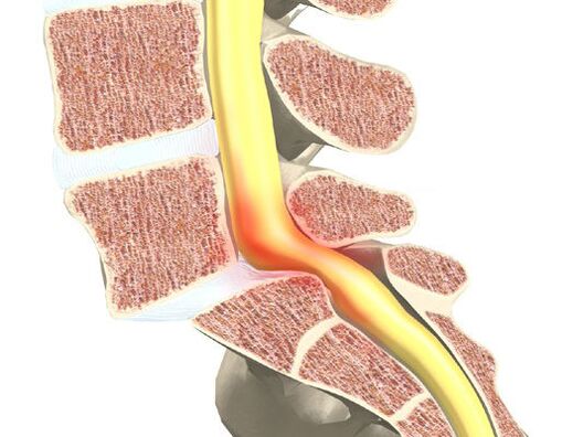 Segmento motorio di sangue per osteocondosi