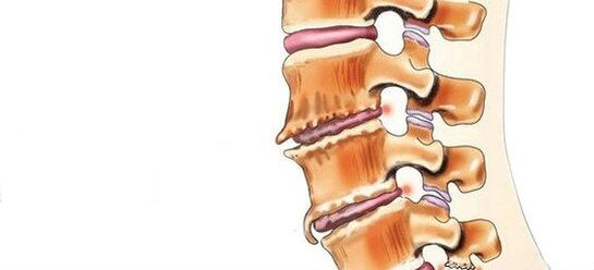 Spondilosi - Distruzione di articolazioni intervertebrali