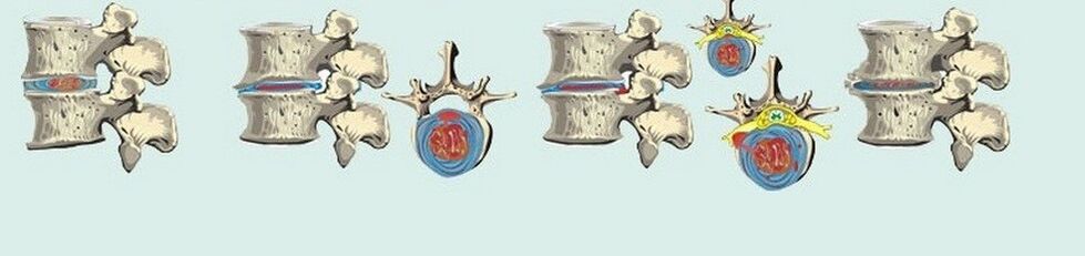 vari stadi dell'osteocondrosi toracica