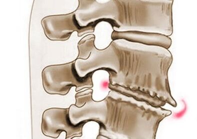 danno alle vertebre nell'osteocondrosi toracica
