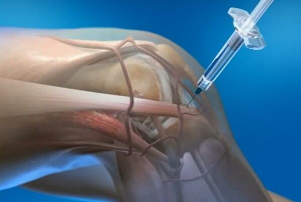 iniezioni intra-articolari per l'artrosi dell'articolazione del ginocchio