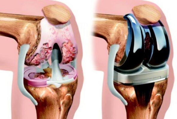 prima e dopo l'artrosi dell'articolazione del ginocchio per l'artrosi