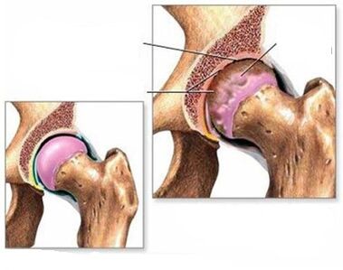 artrosi dell'articolazione dell'anca